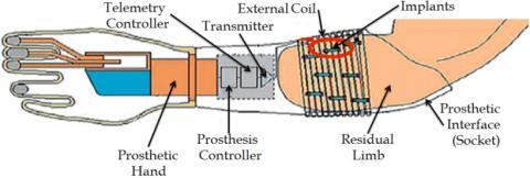 How myoelectric prostheses works